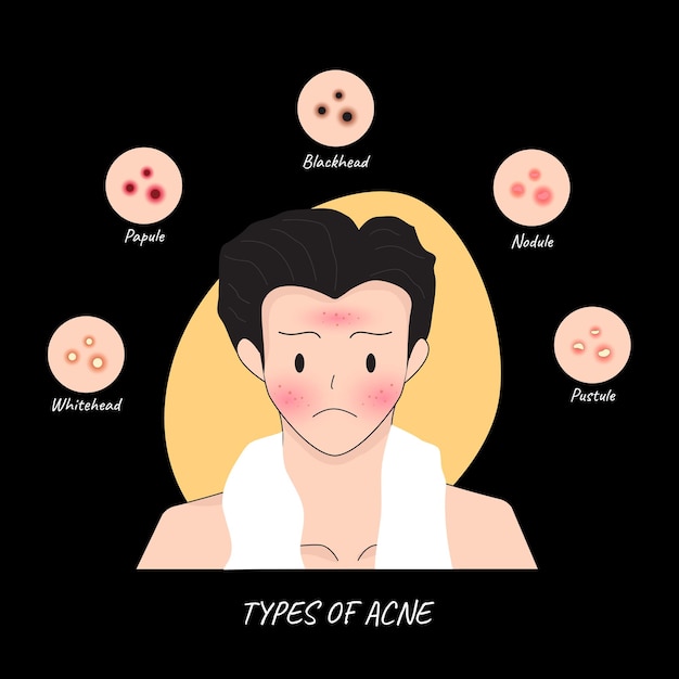 Vecteur illustrations les types d'acné surviennent sur le visage d'un homme