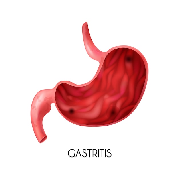 Vecteur image médicale réaliste de l'estomac humain avec gastrite sur illustration vectorielle fond blanc