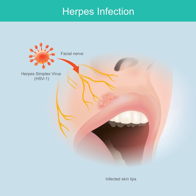 Vecteur infection à l'herpès. illustration de la peau du nerf facial humain à utiliser pour expliquer l'infection des lèvres par le virus de l'herpès simplex.