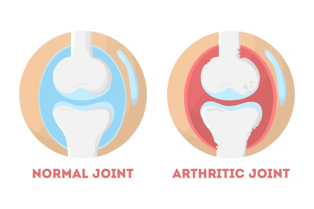 Vecteur infographie anatomique des articulations humaines normales et arthritiques