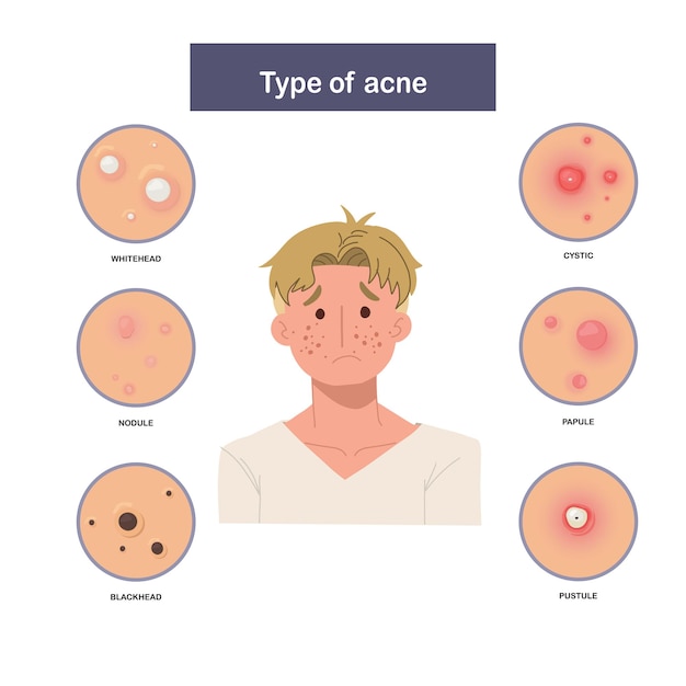 Vecteur infographie du type d'acné homme triste et inquiet avec acné illustration vectorielle plane