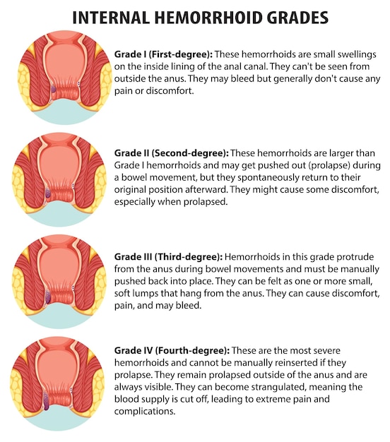 Vecteur infographie éducative sur les grades des hémorroïdes internes