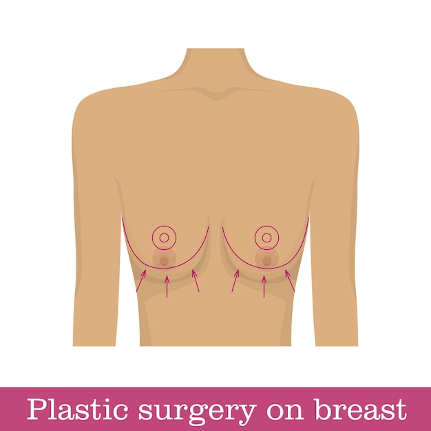 Vecteur infographie sur le lifting mammaire en chirurgie plastique schéma de correction chirurgicale du sein par méthode de lifting pour les chirurgiens et les illustrateurs diagramme de correction du buste sous la forme d'une illustration vectorielle