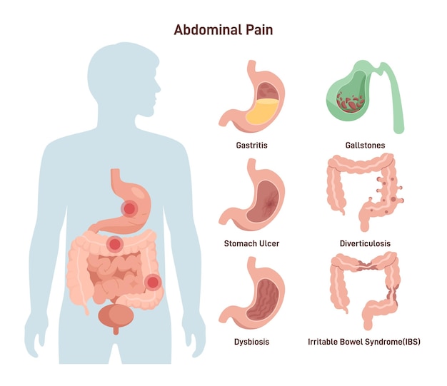 Vecteur infographie médicale de douleur abdominale de différents organes abdominaux