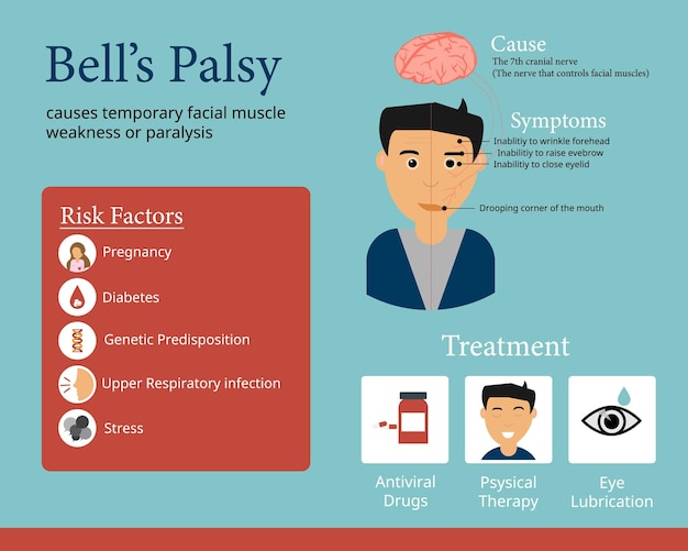 Vecteur infographie sur la paralysie de bell pour montrer la cause du symptôme