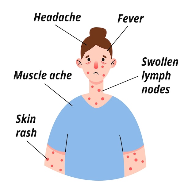 Infographie Des Symptômes Du Virus De La Variole Du Singe Sur Une Patiente Souffrant De Fièvre, De Maux De Tête, D'éruptions Cutanées De Ganglions Lymphatiques Enflés Sur Le Visage, Le Corps Et Les Douleurs Musculaires Du Dos