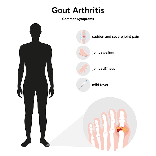 Vecteur informations médicales goutte arthrite symptômes fréquents