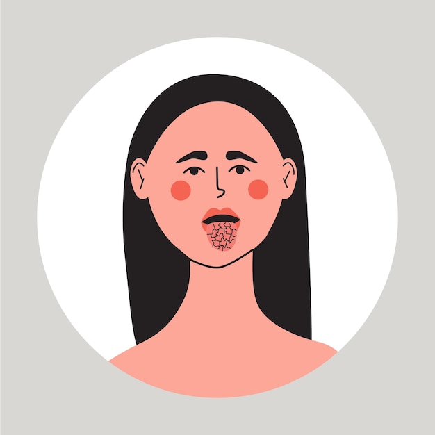 Vecteur jeune femme avec problème de xérostomie bouche et langue sèche illustration médicale vectorielle plate