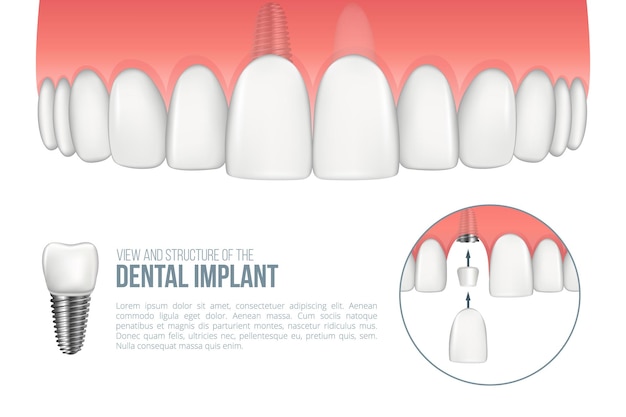 Mâchoire supérieure réaliste avec dent saine et schéma d'implant dentaire avec l'installation