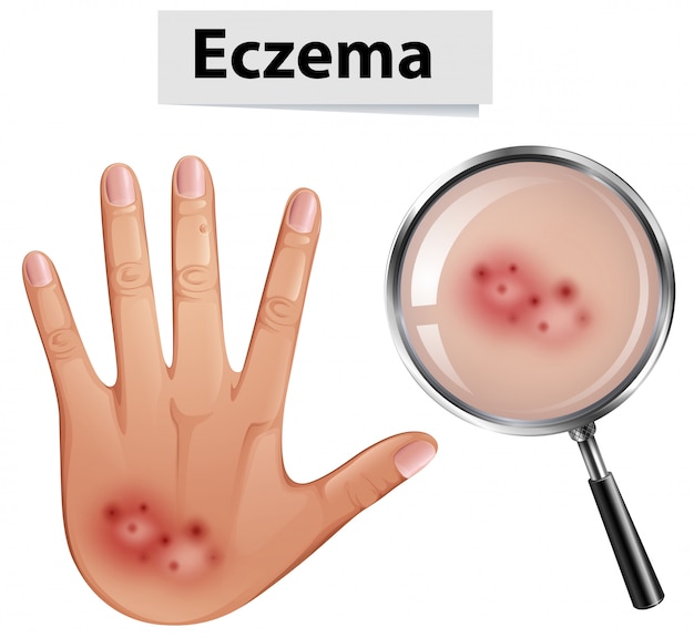 Une Main Humaine Avec L'eczéma