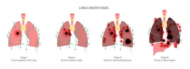 Vecteur maladie cancéreuse des poumons