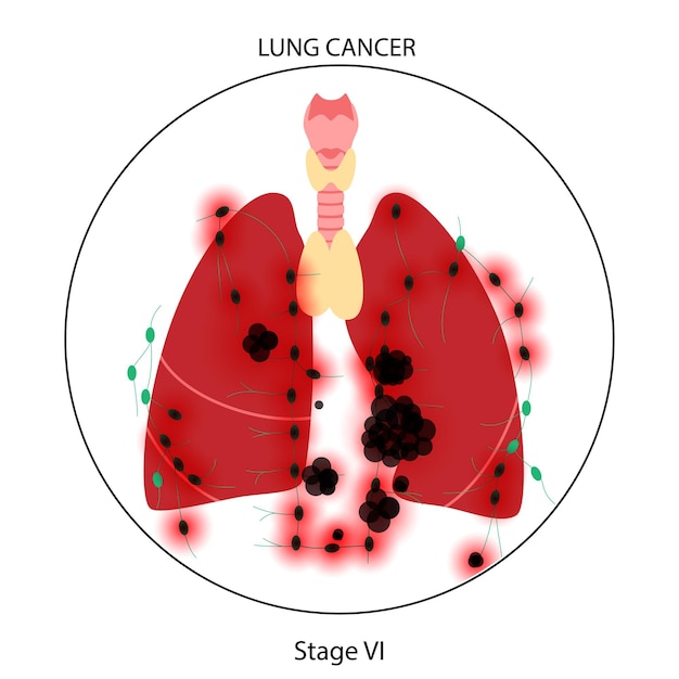 Vecteur maladie cancéreuse des poumons