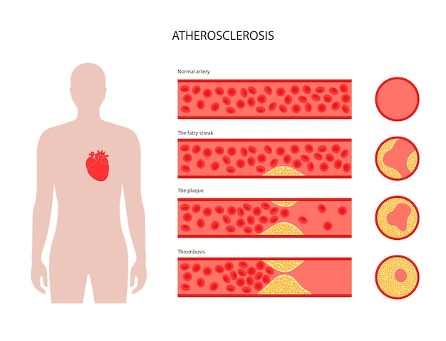 Vecteur maladie cardiaque liée au cholestérol