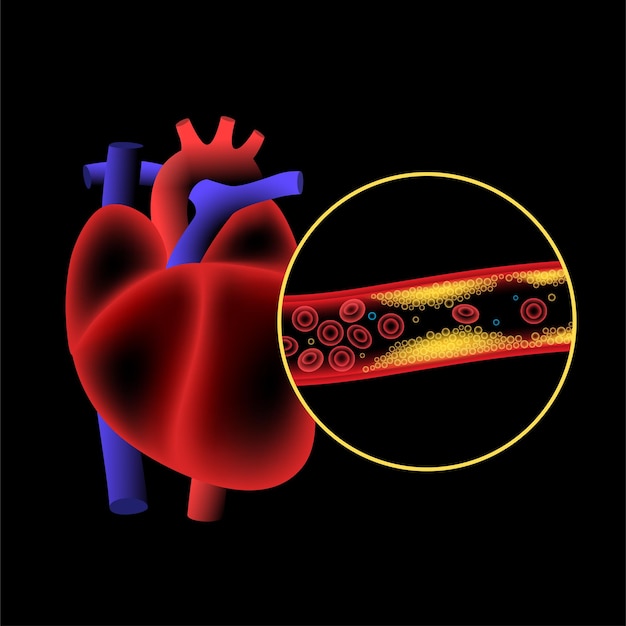 Maladie cardiaque liée au cholestérol