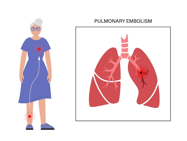 Vecteur maladie d'embolie pulmonaire