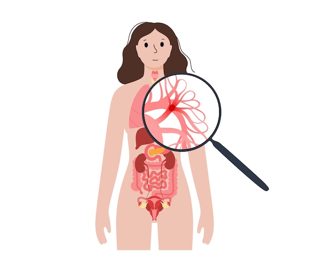 Vecteur maladie d'embolie pulmonaire