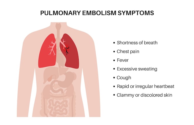 Vecteur maladie d'embolie pulmonaire