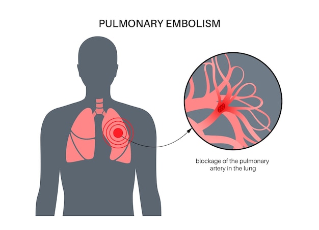 Vecteur maladie d'embolie pulmonaire