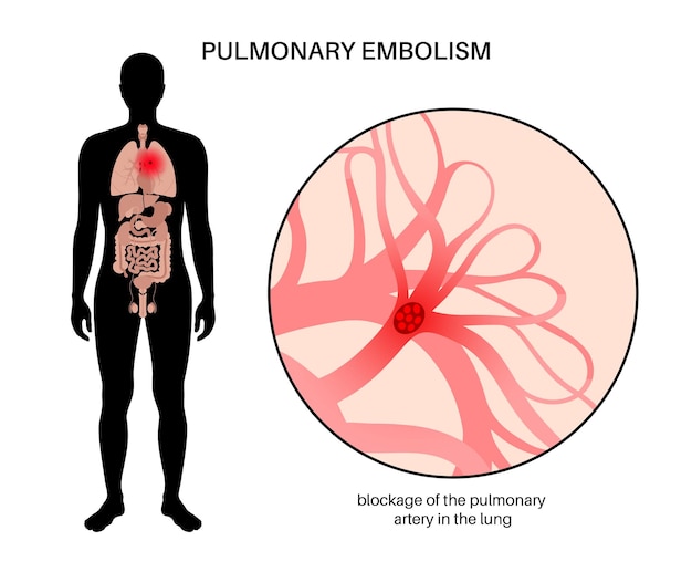 Vecteur maladie d'embolie pulmonaire