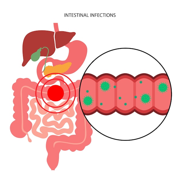 Maladie Des Infections Intestinales