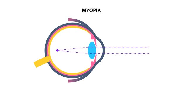 Vecteur maladie oculaire de la myopie