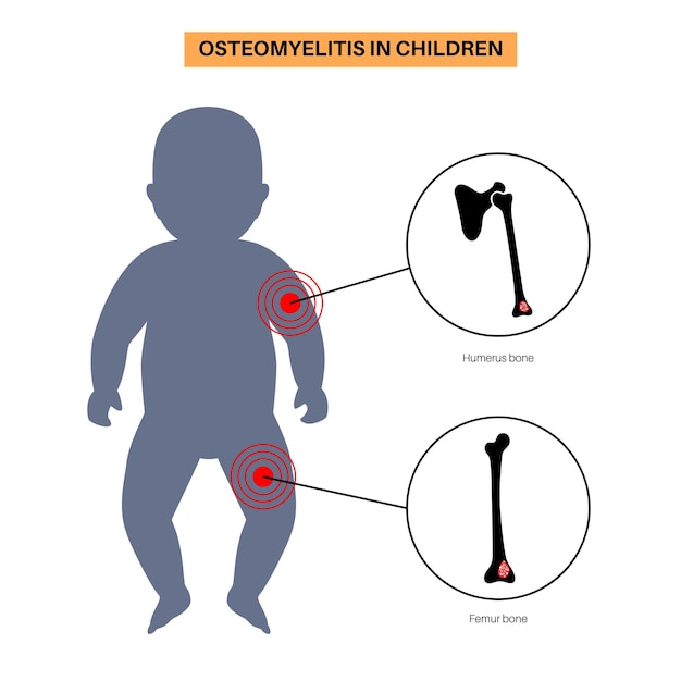 Vecteur maladie d'ostéomyélite chez les enfants cas courants os infectés des bras et des jambes l'infection se propage par la circulation sanguine jusqu'aux os de l'humérus et du fémur bactéries dans le vecteur médical du corps du nourrisson