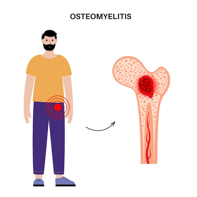 Maladie De L'ostéomyélite Douleur De Hanche Infectée Et Rougeur Sus-jacente L'infection Se Propage Par La Circulation Sanguine Dans L'os Du Fémur Bactéries Staphylococcus Aureus Dans L'illustration Vectorielle Du Corps Humain