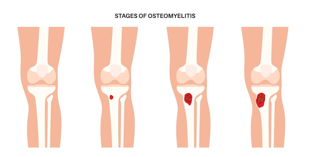Vecteur maladie de l'ostéomyélite douleur des os morts du genou infecté et rougeur sus-jacente l'infection se propage par la circulation sanguine dans la bactérie staphylococcus aureus du tibia dans l'illustration vectorielle du corps humain