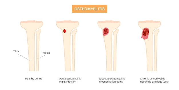 Vecteur maladie de l'ostéomyélite douleur des os morts du genou infecté et rougeur sus-jacente l'infection se propage par la circulation sanguine dans la bactérie staphylococcus aureus du tibia dans l'illustration vectorielle du corps humain