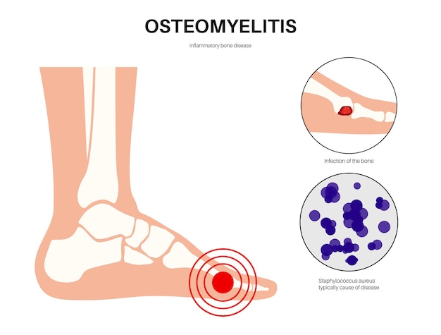 Vecteur maladie de l'ostéomyélite douleur des os des pieds infectés et rougeur sus-jacente l'infection se propage par la circulation sanguine dans la bactérie staphylococcus aureus du pied dans l'illustration vectorielle du corps humain