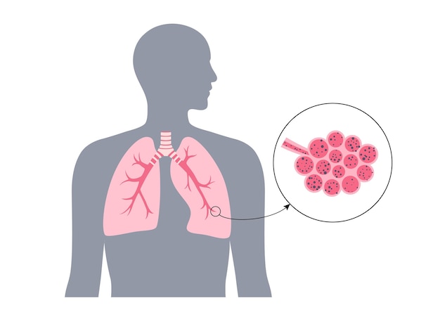 Vecteur maladie pulmonaire à pneumoconiose