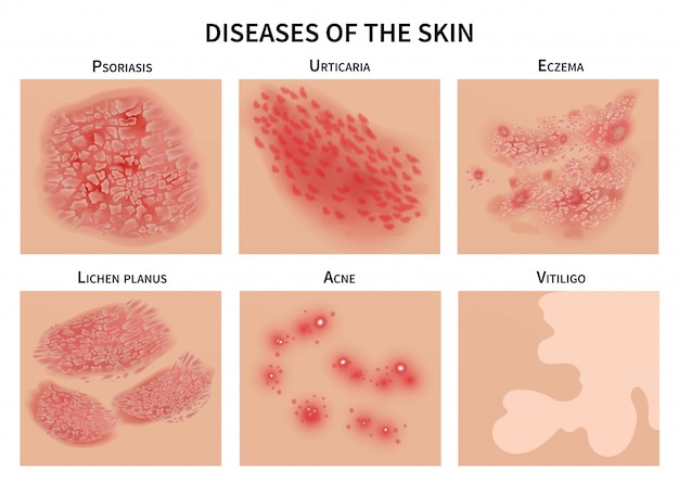 Vecteur maladies de la peau. infection dermique, eczéma et psoriasis. illustration dermatologie