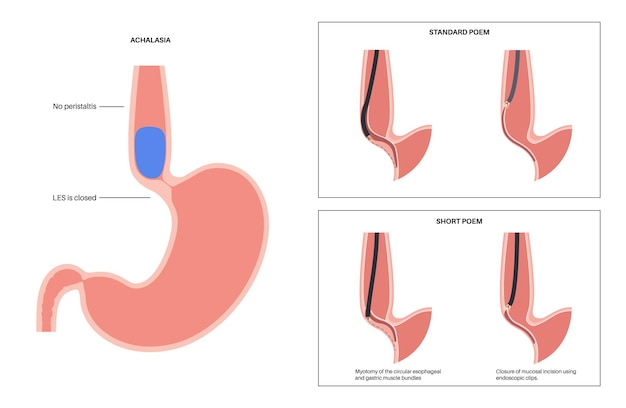 Myotomie Endoscopique Perorale Poem Procédure Mini-invasive Trouble De L'achalasie De L'œsophage Sphincter œsophagien Inférieur Fermé Illustration Vectorielle D'affiche Anatomique Gastro-œsophagienne