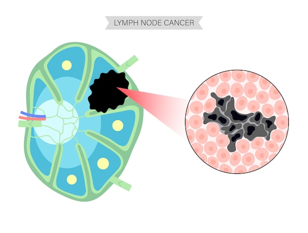 Notion De Cancer Du Lymphome