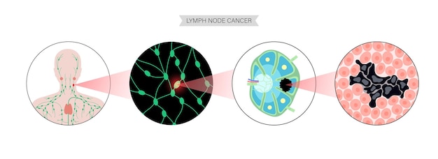 Vecteur notion de cancer du lymphome