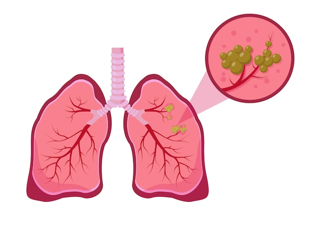Notion de cancer du poumon. Illustration de la maladie pulmonaire sur fond blanc.