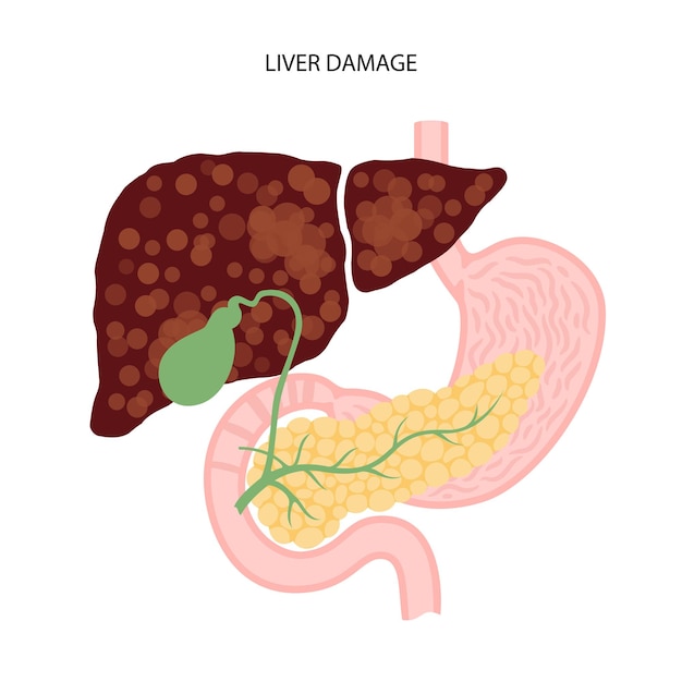 Vecteur notion de maladie du foie