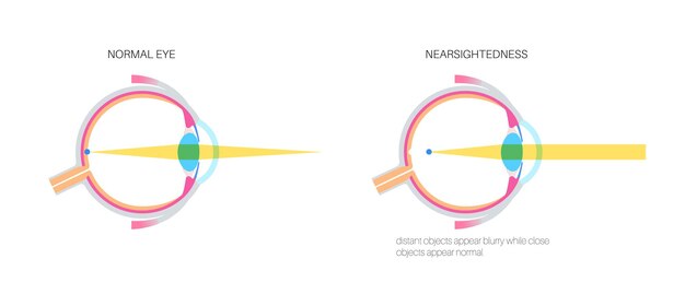 Vecteur oeil normal et myopie