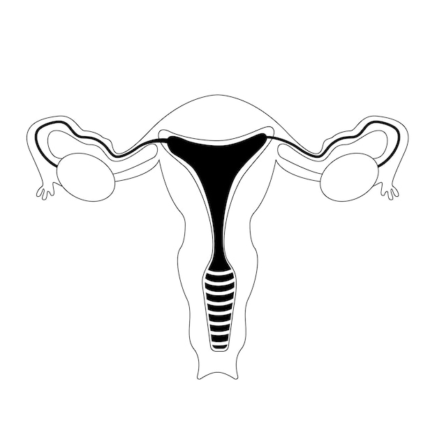 Les Organes Génitaux Féminins Décrivent L'illustration Vectorielle De L'endométriose