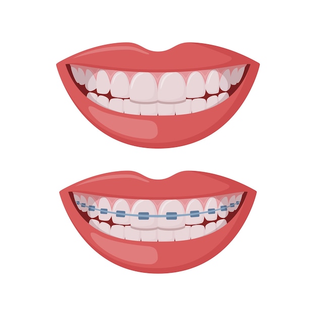 Orthodontie corrective Bouche souriante féminine avec des dents et des appareils dentaires sains