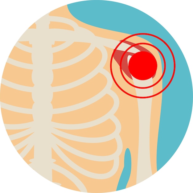 Vecteur l'os de l'épaule a un signal rouge maladie de l' épaule blessure de l' épaule illustration sur le diagnostic du corps