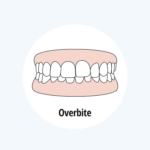Overbite Illustration vectorielle de problème dentaire Concept de soins dentaires