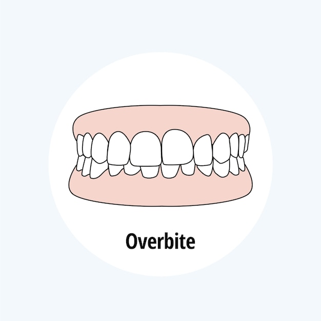 Overbite Illustration Vectorielle De Problème Dentaire Concept De Soins Dentaires