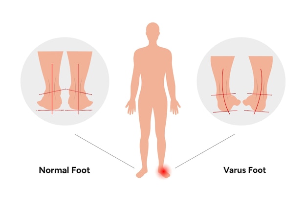 Vecteur le pied normal et le pied varus