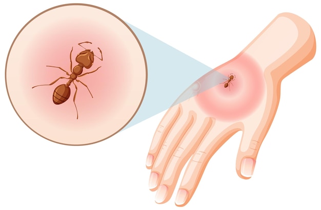 Les Piqûres De Fourmis Piquent Sur La Peau | Vecteur Premium