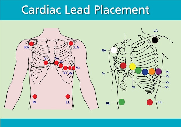 Vecteur placement du plomb cardiaque