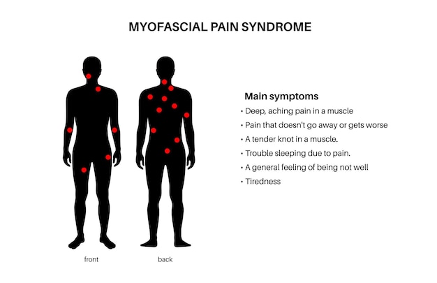 Vecteur points de déclenchement myofasciaux