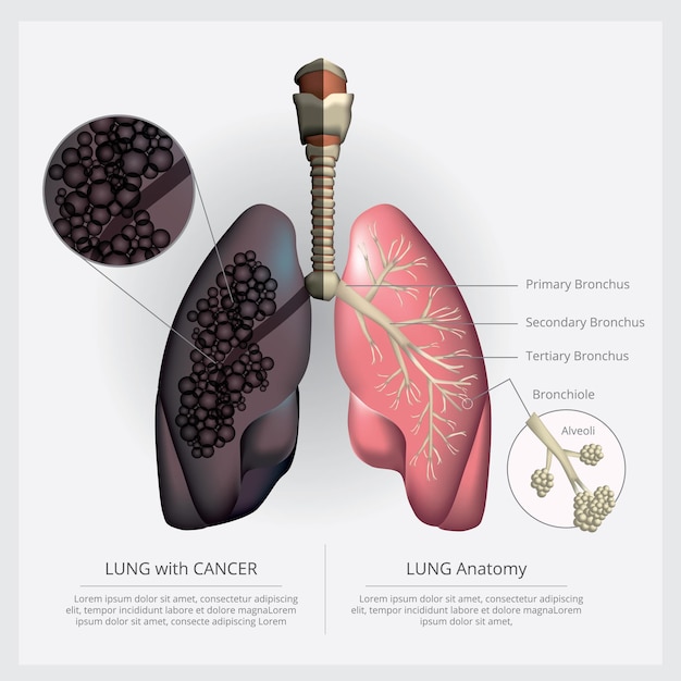 Vecteur poumon avec détail et illustration du cancer du poumon