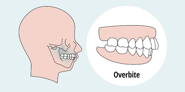 Vecteur problème de dent. vue de côté homme avec des dents mal alignées. malocclusion