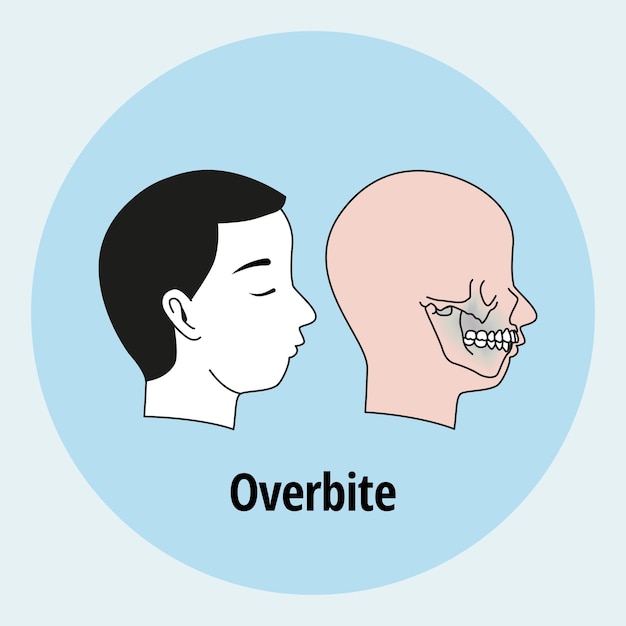 Problème de dent. Vue de côté homme avec des dents mal alignées. Malocclusion